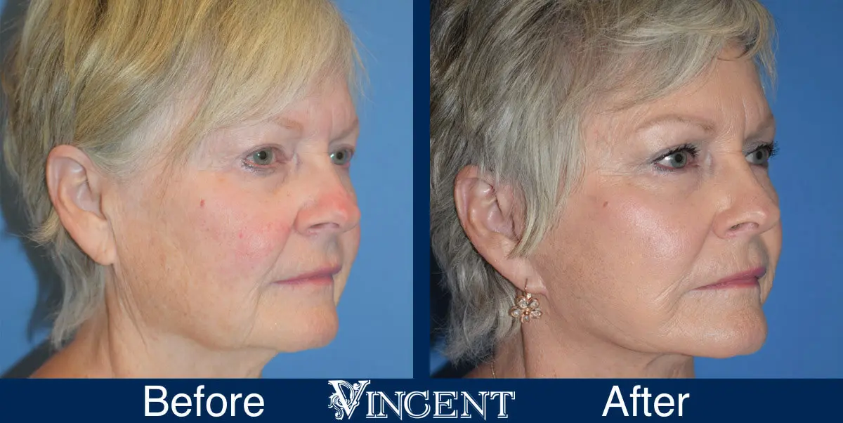 swift-lift-before-and-after-facelift-right-1