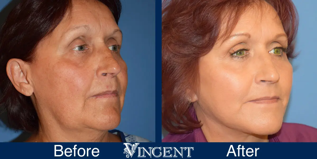 swift-lift-before-and-after-facelift-right-3