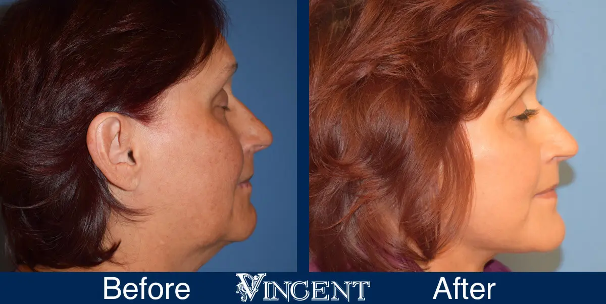 swift-lift-before-and-after-facelift-side-1-2