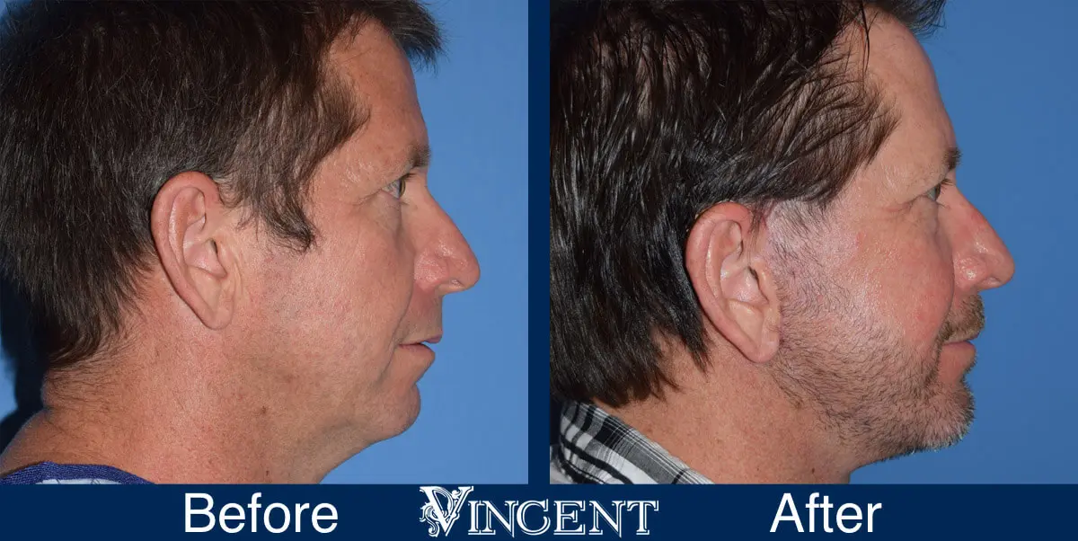 swift-lift-before-and-after-facelift-side-1